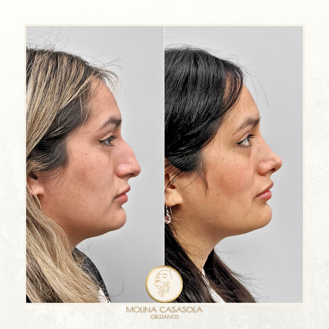 Antes y después rinomodelación Valencia Antes y después rinoplastia ultrasonica Valencia