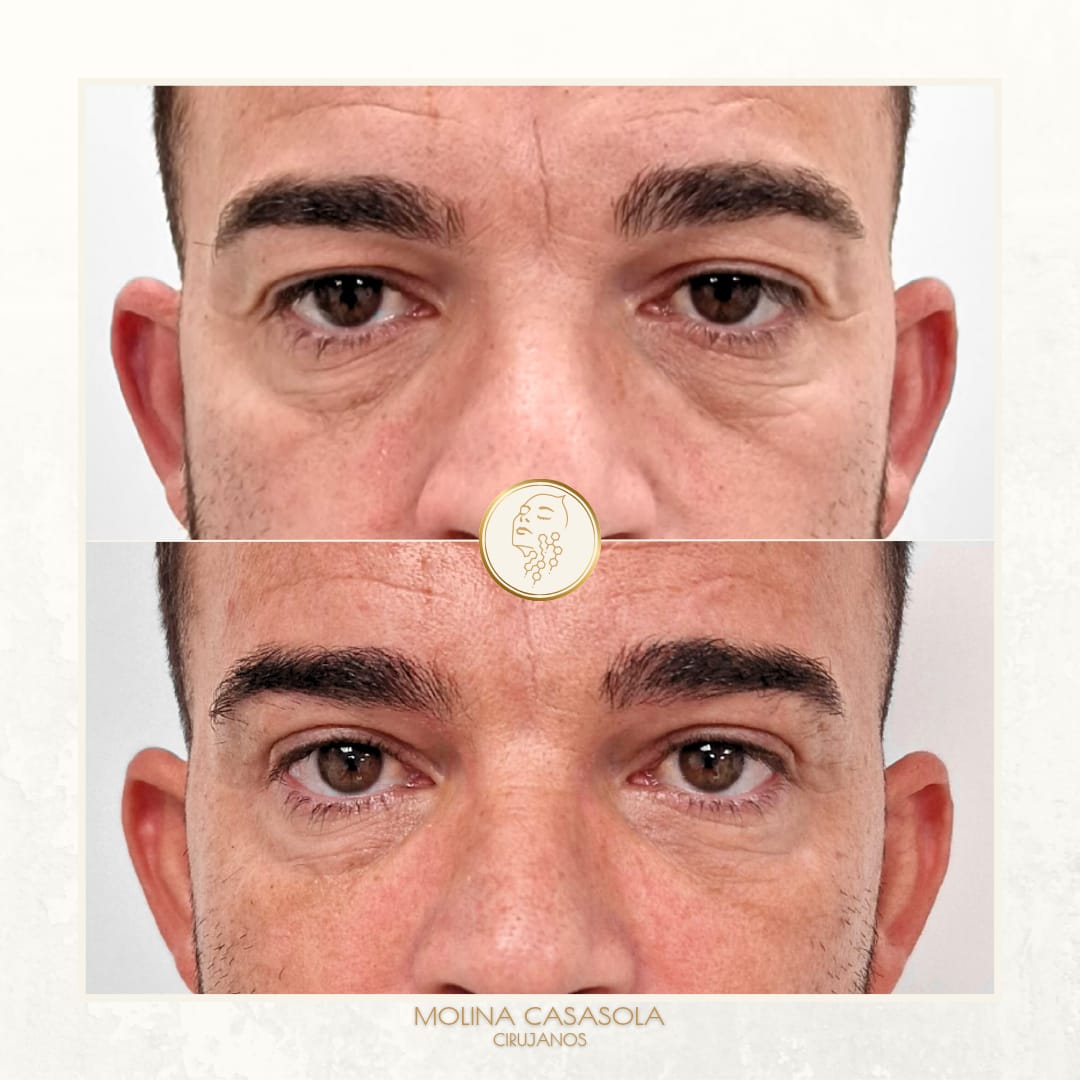 Antes y después Blefaroplastia Valencia Antes y después Blefaroplastia Valencia
