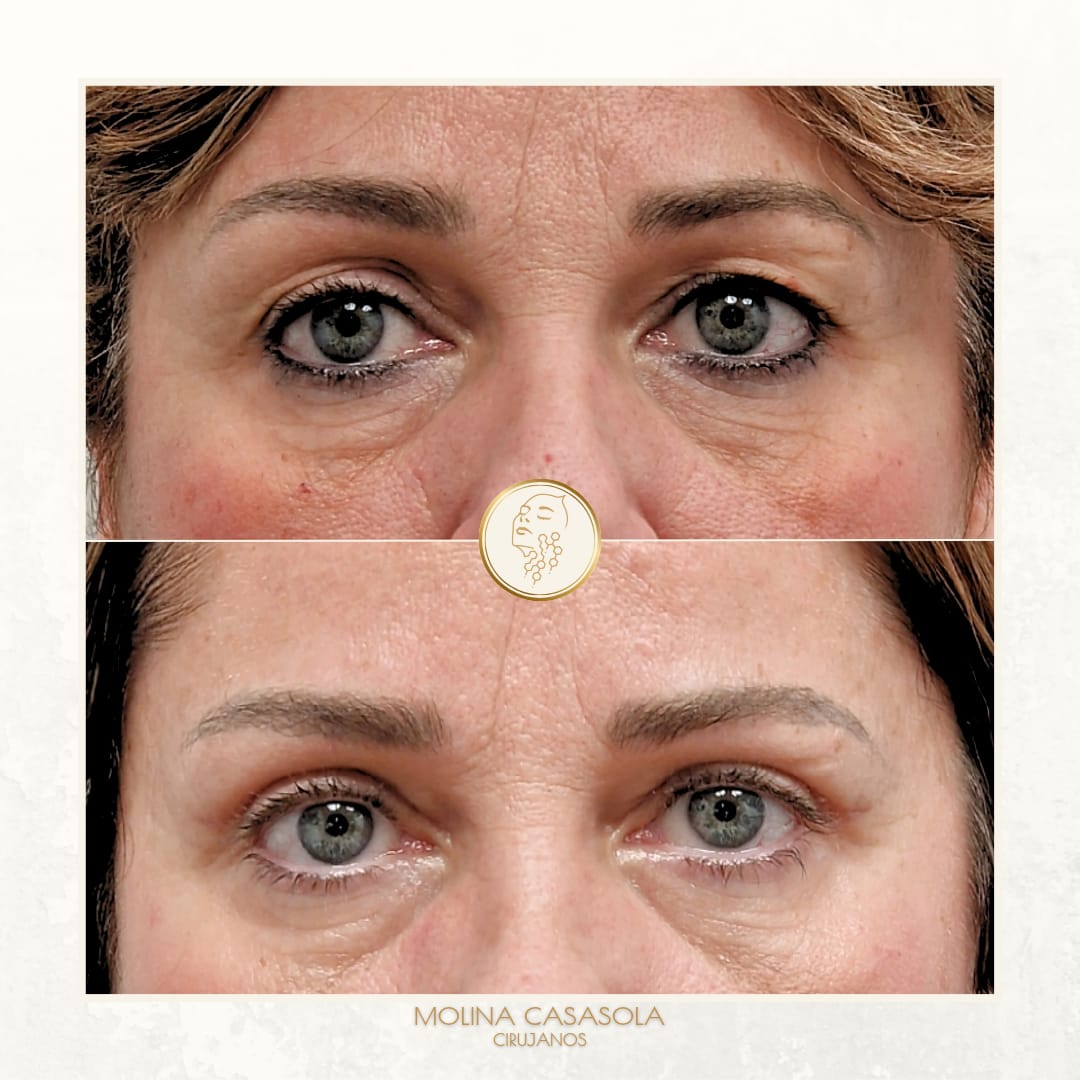Blefaroplastia Valencia Blefaroplastia Valencia