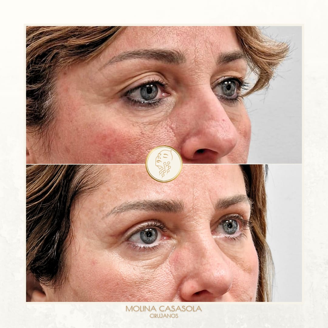 Antes y después Blefaroplastia Valencia Antes y después Blefaroplastia Valencia