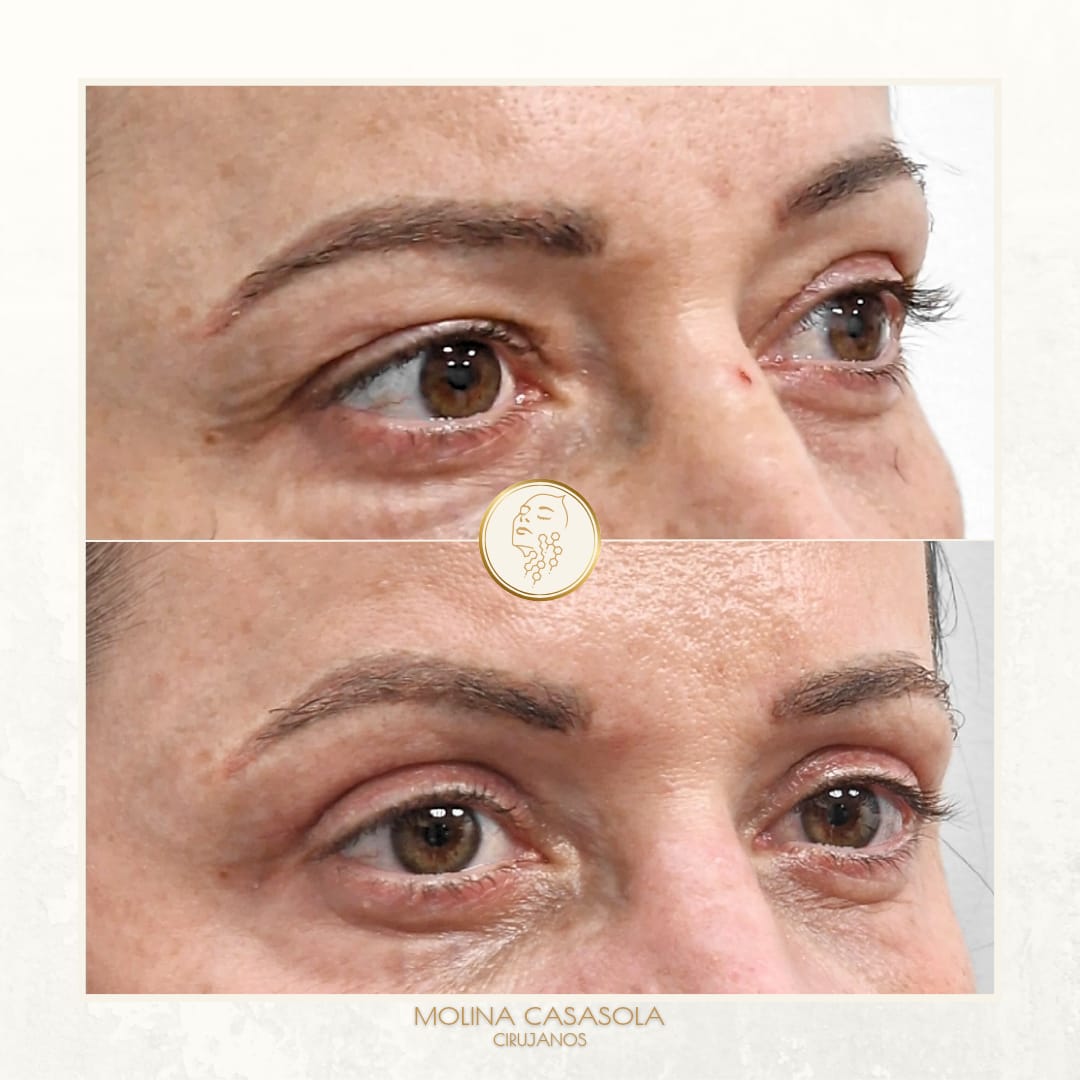 Antes y después Blefaroplastia Valencia Antes y después Blefaroplastia Valencia