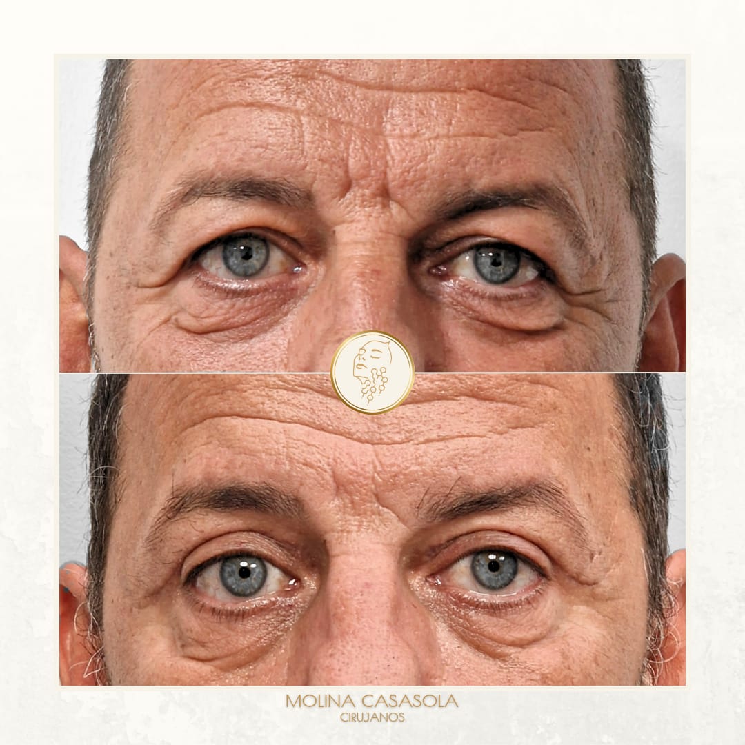 Blefaroplastia Valencia Blefaroplastia Valencia
