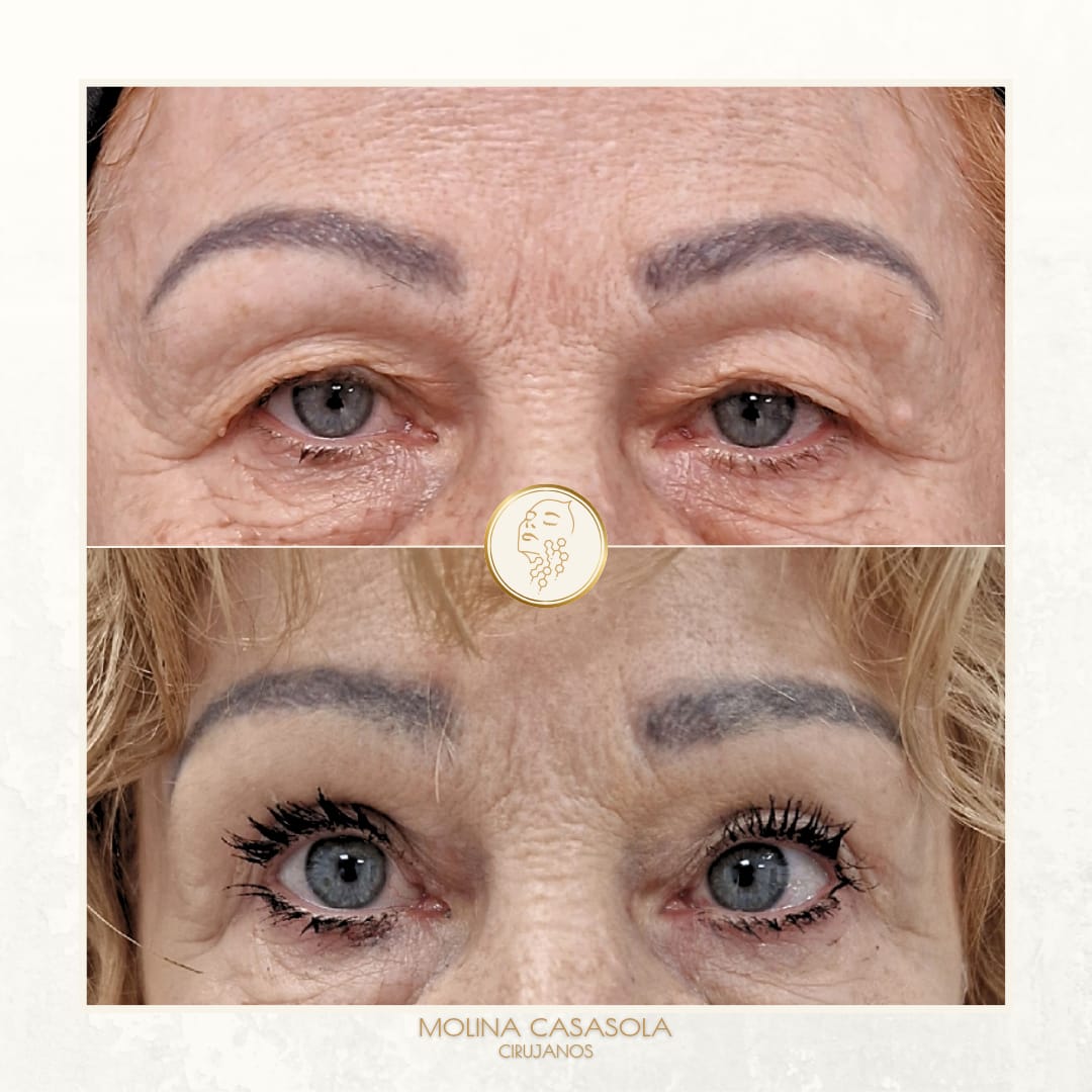 Antes y después Blefaroplastia Valencia Antes y después Blefaroplastia Valencia
