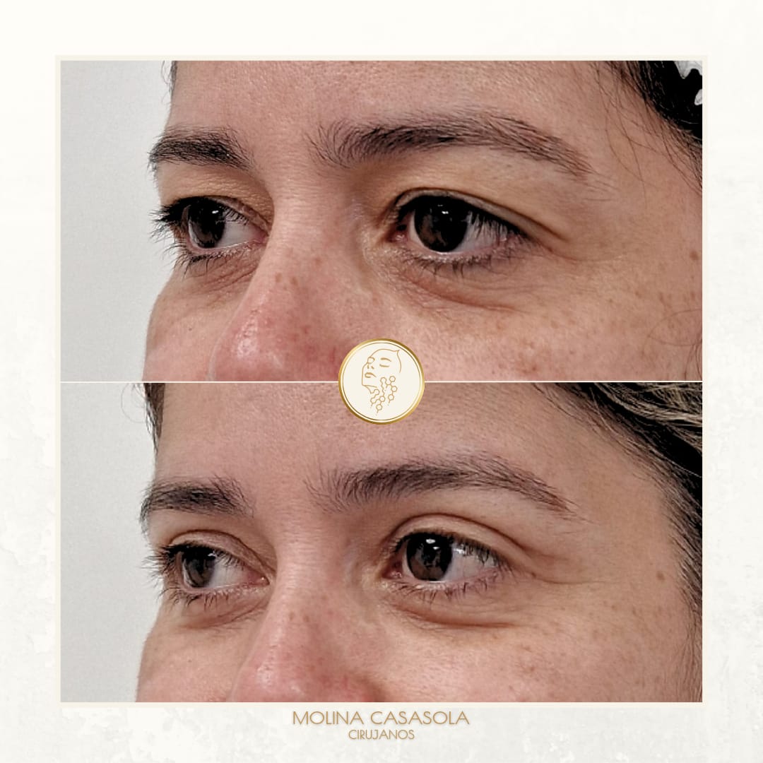 Blefaroplastia Valencia Blefaroplastia Valencia