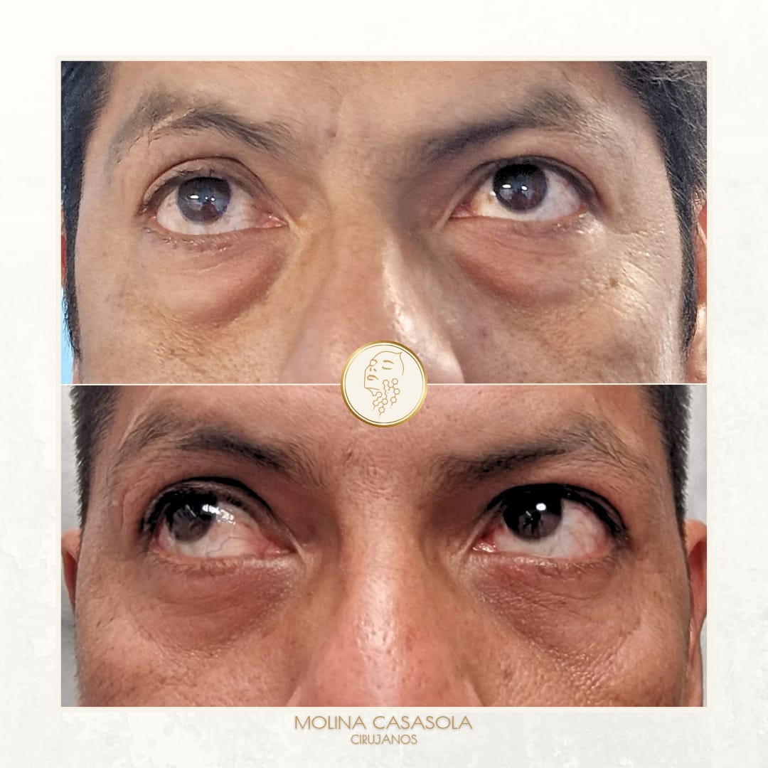 Blefaroplastia Valencia Blefaroplastia Valencia