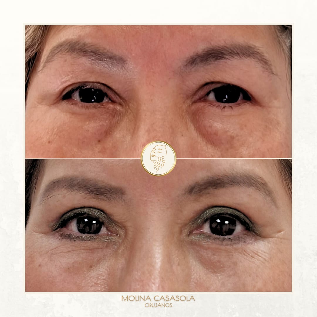 Blefaroplastia Valencia Blefaroplastia Valencia