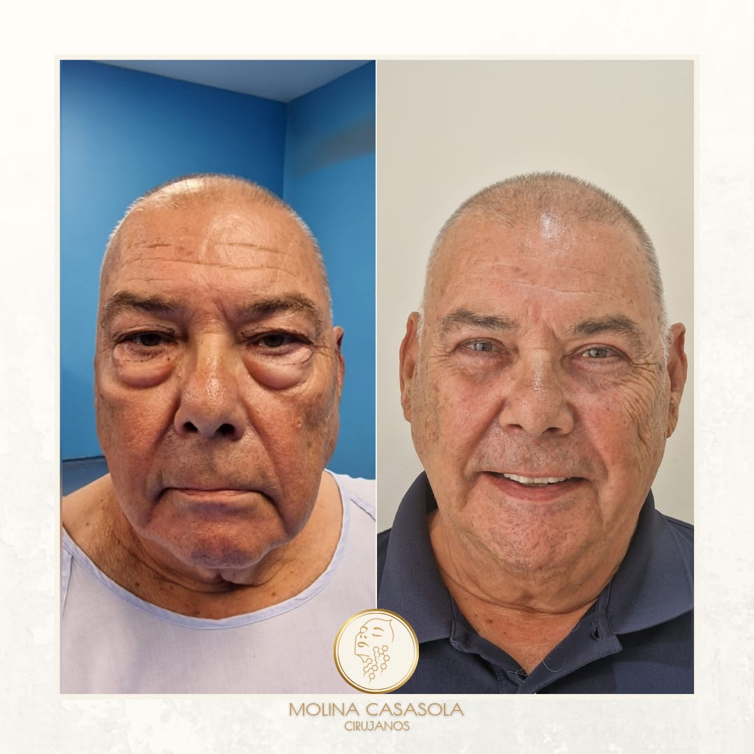 Blefaroplastia completa en Valencia Blefaroplastia completa en Valencia