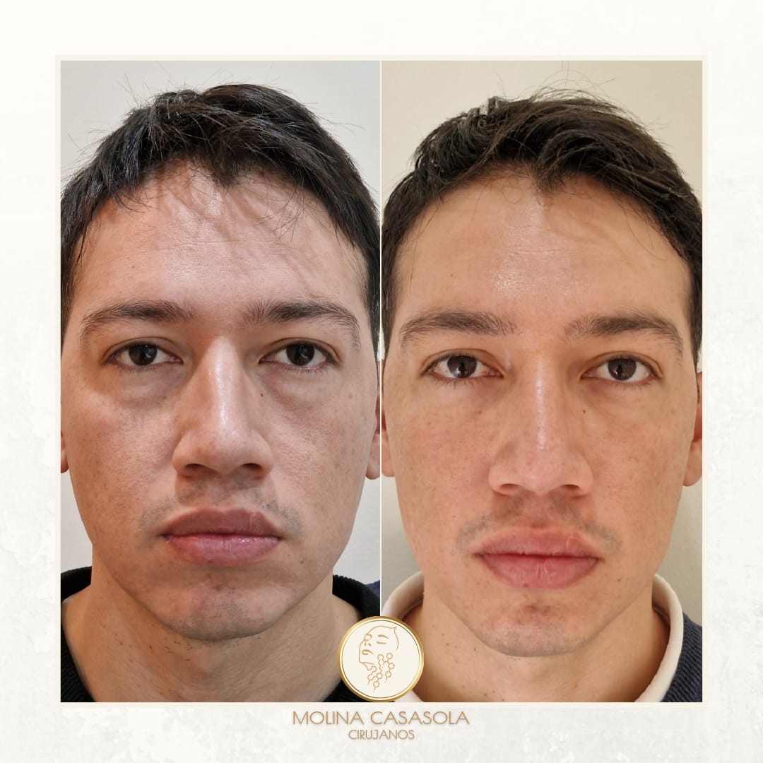 blefaroplastia inferior antes y despues blefaroplastia inferior antes y despues