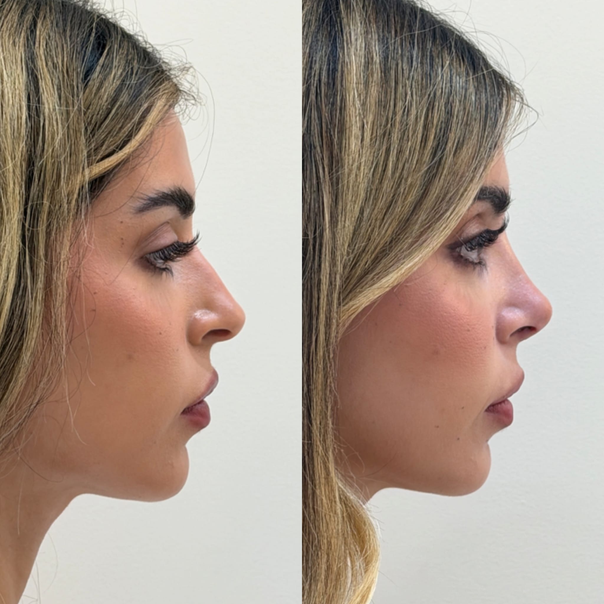 WhatsApp Image 2026-09-02 at 11.42.36 (2) caso rinoplastia ultrasonica Valencia