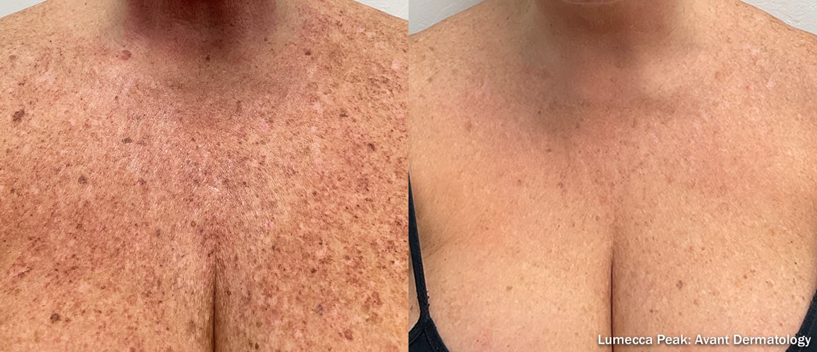 Antes y después de IPL Lumecca Peak en escote: reducción de manchas y daño solar