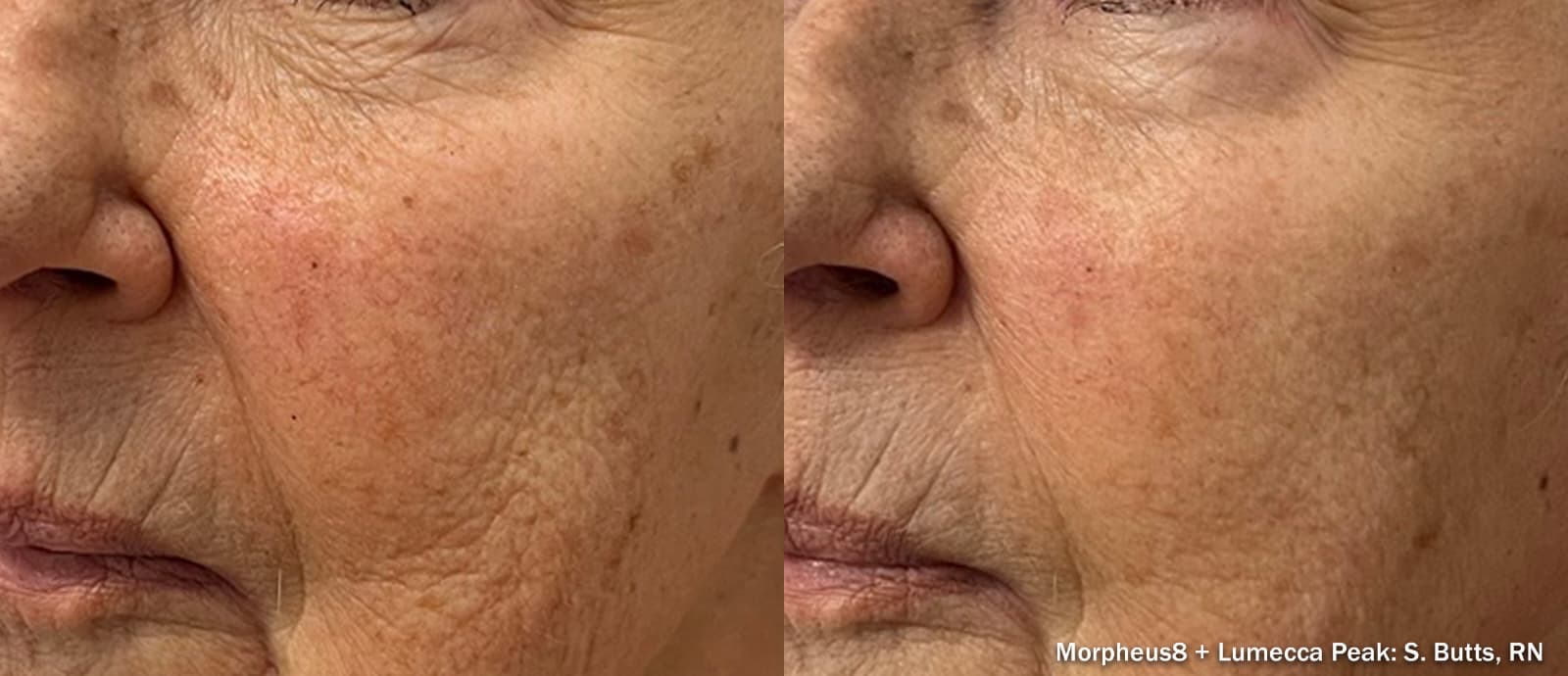 Antes y después de Morpheus8 combinado con Lumecca Peak en mejilla: piel más uniforme