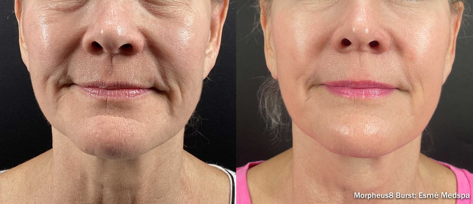 Antes y después de un tratamiento con Morpheus8 en la parte inferior del rostro y el cuello, vista frontal