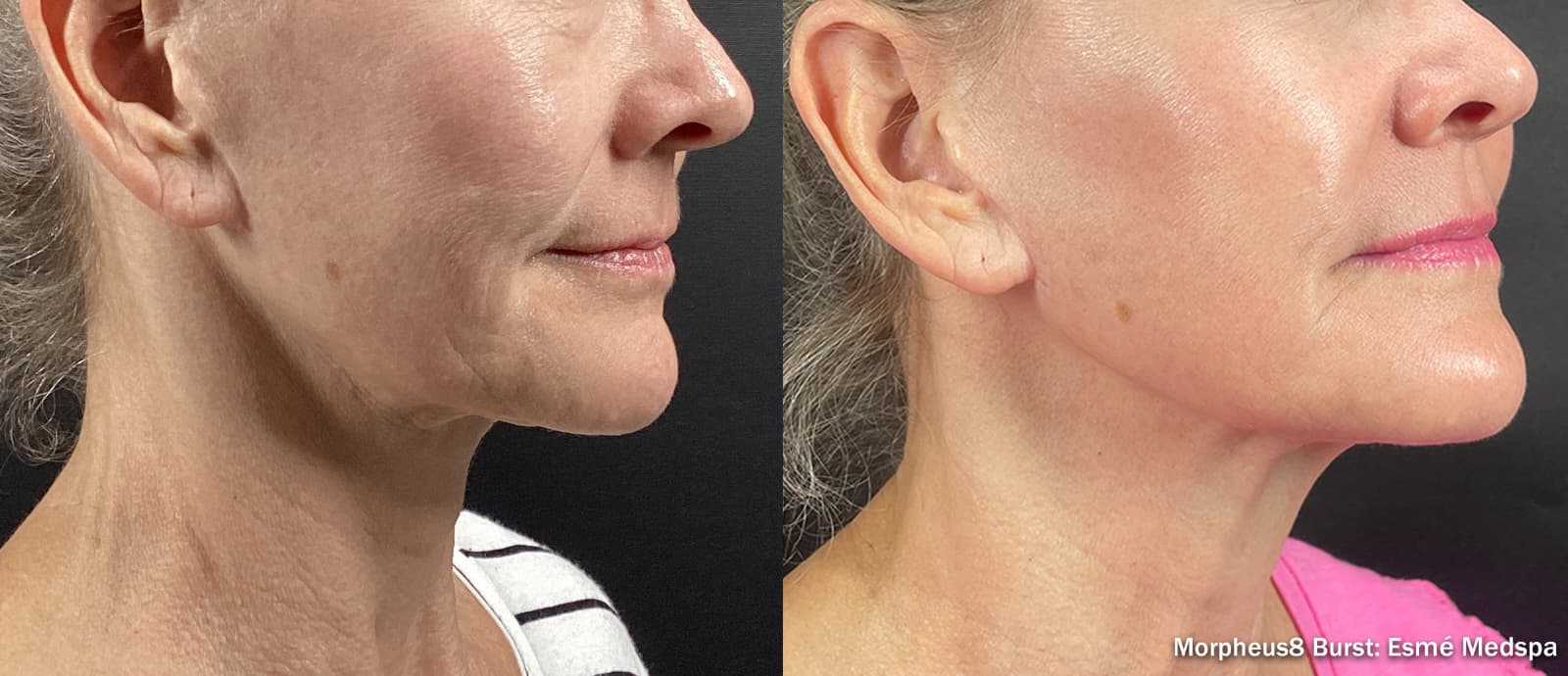 Antes y después de Morpheus8 en el contorno mandibular y el cuello, vista de perfil