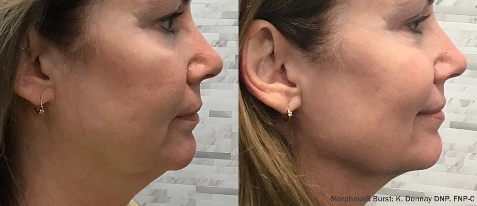 Antes y después de Morpheus8 en mejilla y óvalo facial, vista de perfil